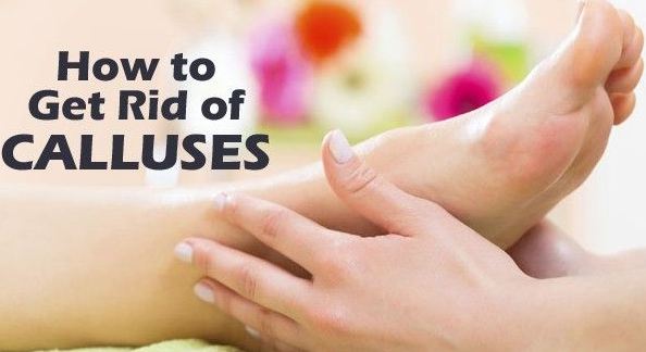 How to Get Rid of Calluses on Bottom of Foot