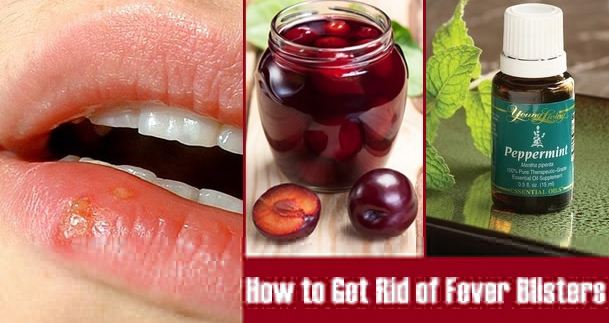 How to Get Rid of Fever Blisters Fast