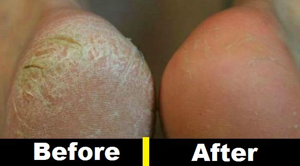How to Get Rid of Calluses on Feet with Listerine Easily