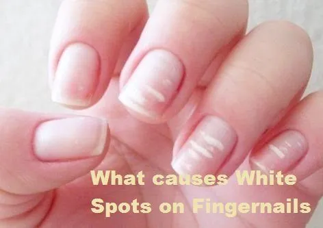 What causes White Spots on Fingernails
