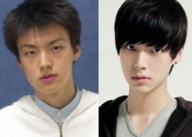 Plastic Surgery Before and After Korean