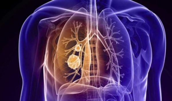 The Major Causes of Mesothelioma