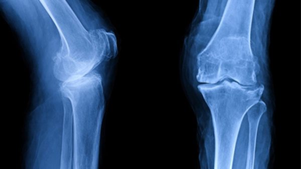 What Is the Best Treatment for Osteoarthritis