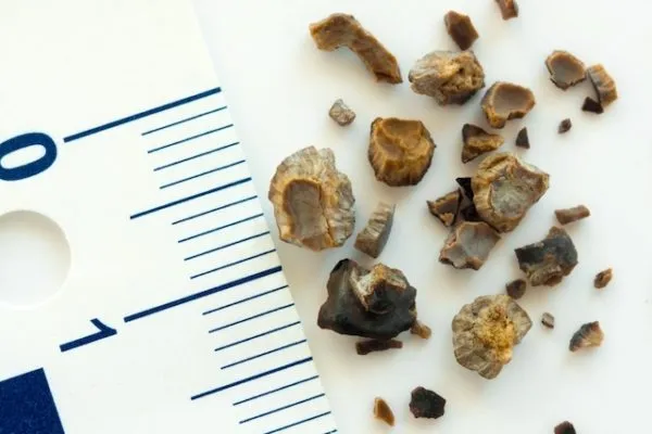 Kidney Stone: Causes, Symptoms and How to Eliminate