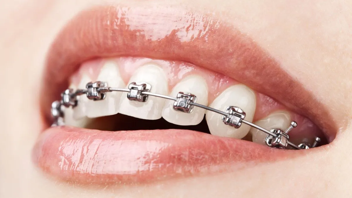 How to Take Good Care of Your Braces During Pandemic?